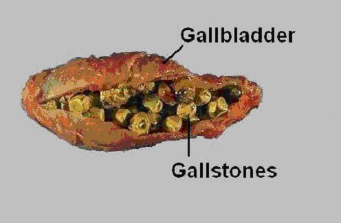 Biliary Colic